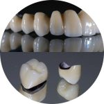Crowns and Bridges Image