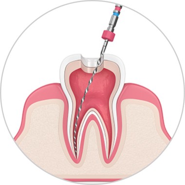 EndodentalTherapyRound Denervation Image
