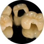 Inlays & Onlays Image