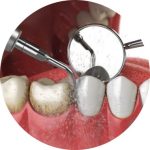 Plaque Removal Image
