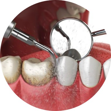 PlaqueRemovalRound Plaque Removal Image