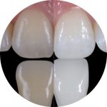 Teeth Whitening Image