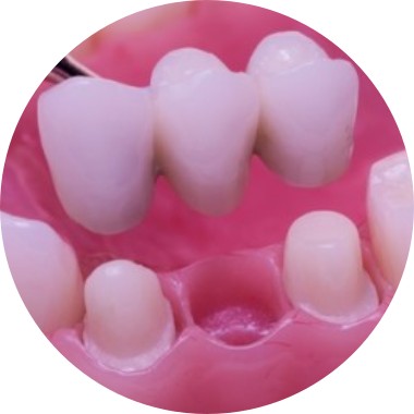 ToothBridgeInstallRound Tooth Bridge Installment Image