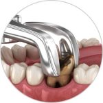 Tooth Extraction Image