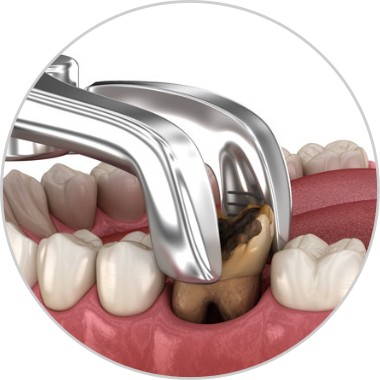 ToothExtraction Tooth Extraction Image